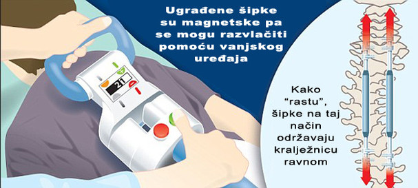Razvlačenje ugrađenih &scaron;ipki pomoću vanjskog uređaja