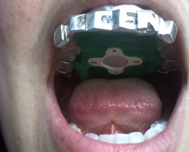 Video: Zubna navlaka kao MP3 player