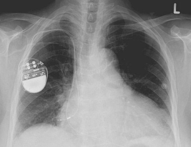 Demonstrirano hakiranje pacemakera