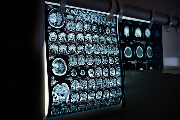 MRI studija prati mozak od rođenja do smrti