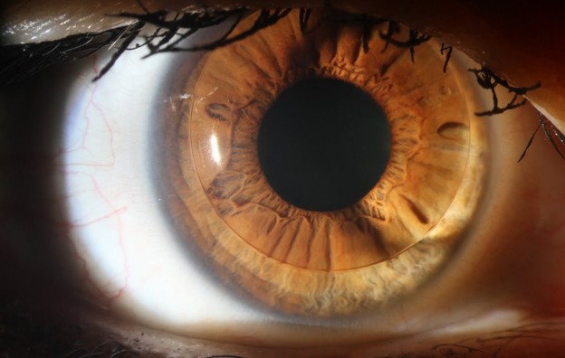 Kontaktne leće koje korigiraju rast očiju