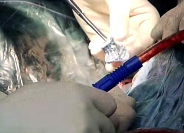 VIDEO: Dječaku ugrađen 3D printani kralježak