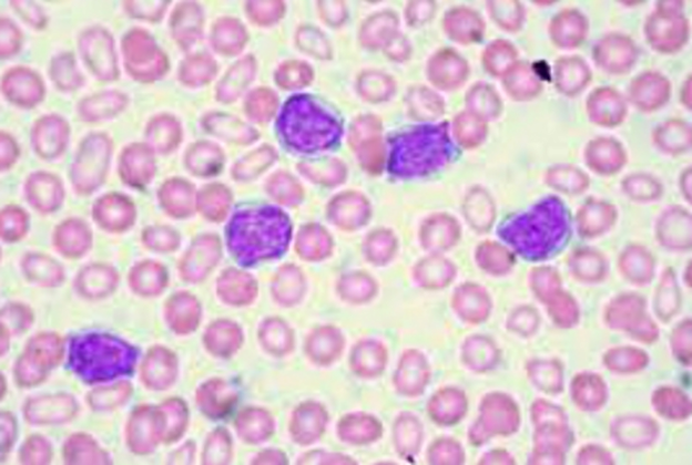 T-limfociti iskorijenili leukemiju kod dvoje djece