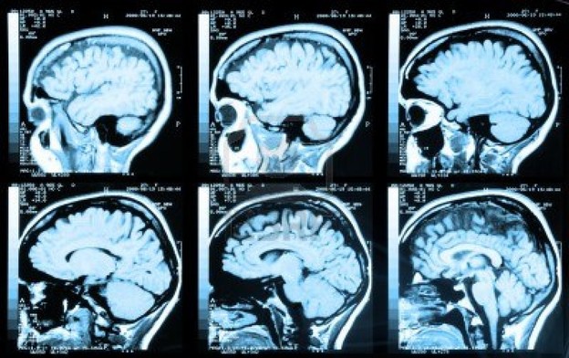 Skeniranje mozga prepoznaje buduće kriminalno ponašanje