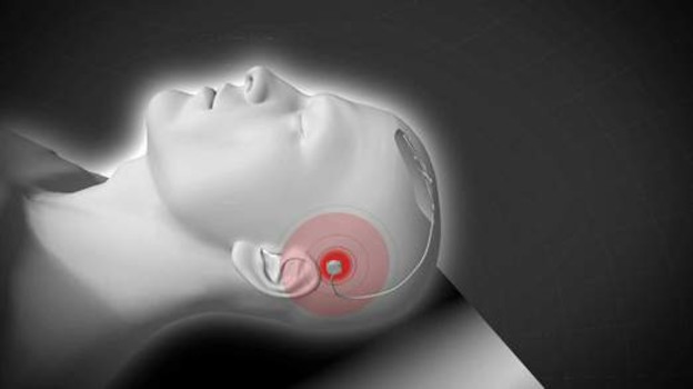 VIDEO: Hi-Tech moždani implantat protiv Parkinsona VIDEO: Hi-Tech moždani implantat protiv Parkinsona