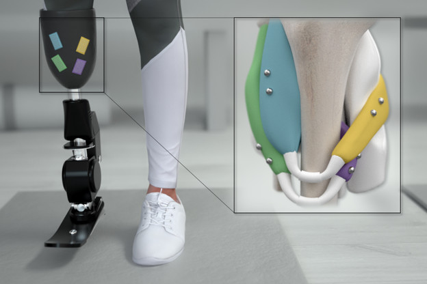 VIDEO: Implantirani magnetski senzori za savršenu protetiku