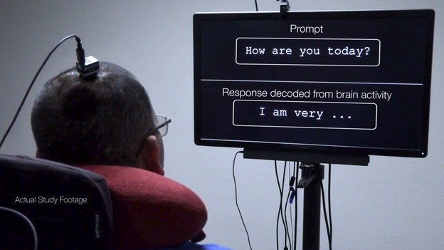 VIDEO: Neuroproteza omogućuje govor moždanim signalima