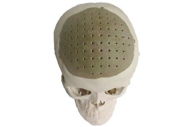 3D isprintani implantat zamijenio 75% pacijentove lubanje 3D isprintani implantat zamijenio 75% pacijentove lubanje