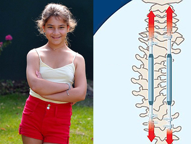 Bionička kralježnica omogućava uspravno hodanje Bionička kralježnica omogućava uspravno hodanje