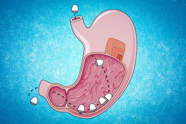 Kapsule s mRNA cjepivom umjesto injekcija Kapsule s mRNA cjepivom umjesto injekcija