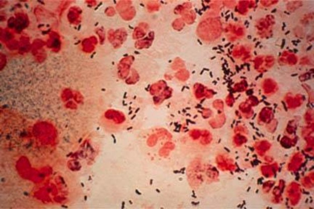 Otkriven soj gonoreje otporan na antibiotike Otkriven soj gonoreje otporan na antibiotike