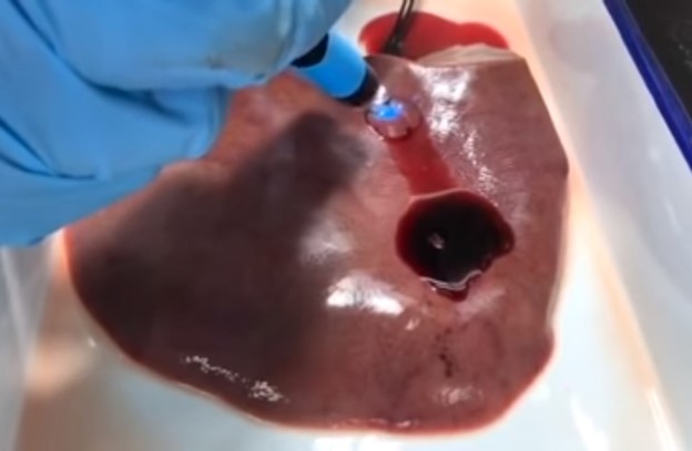 VIDEO: Bioljepilo zatvara rupu na srcu za 20 sekundi VIDEO: Bioljepilo zatvara rupu na srcu za 20 sekundi