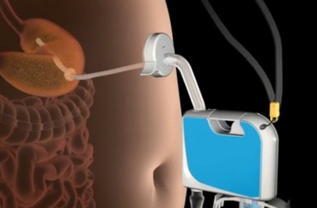 VIDEO: Gadget za izvlačenje hrane iz želuca VIDEO: Gadget za izvlačenje hrane iz želuca