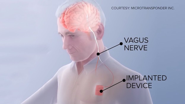 VIDEO: Implantat za oporavak od moždanog udara