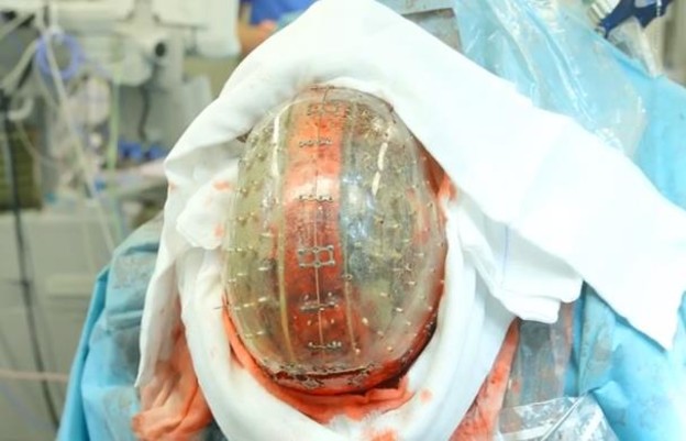 VIDEO: Uspješna transplantacija čitave 3D isprintane lubanje